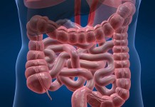 cancer colorectal