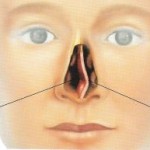 cloison nasale dérivée