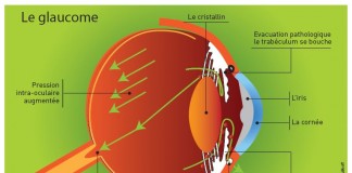 glaucome oeil