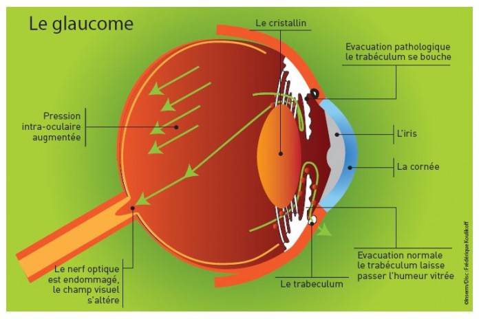 glaucome oeil