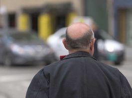 greffe de cheveux